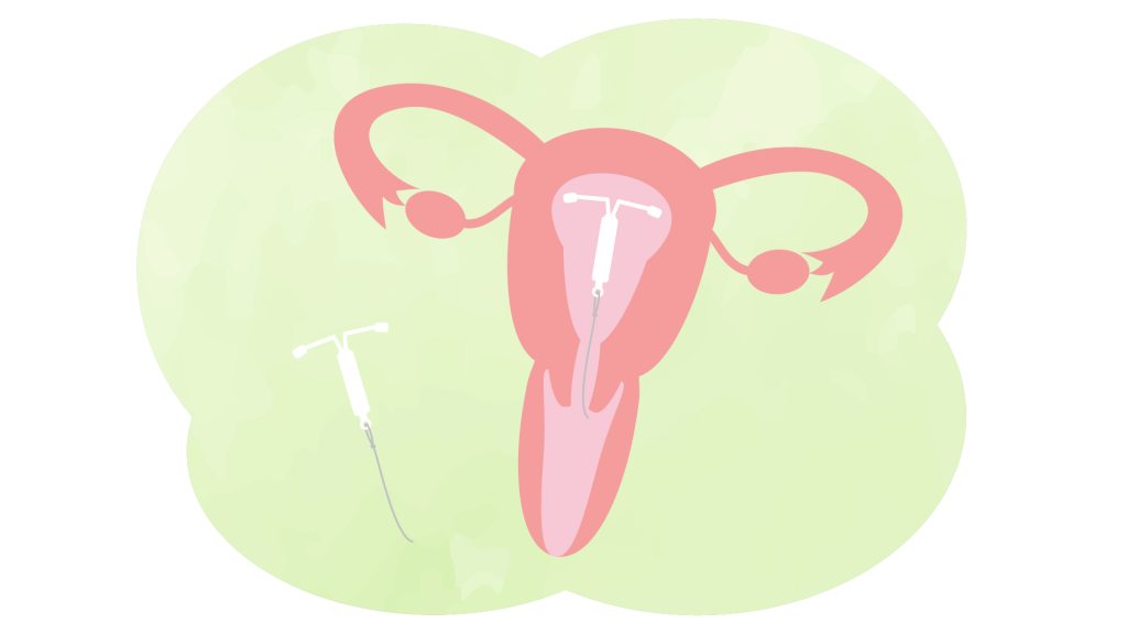 子宮結構與藥性子宮環示意圖,說明子宮環作為經血過多一線治療方法,幫助減少經血量
